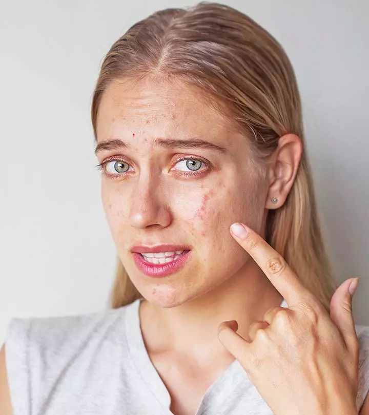 Acne & Breakouts