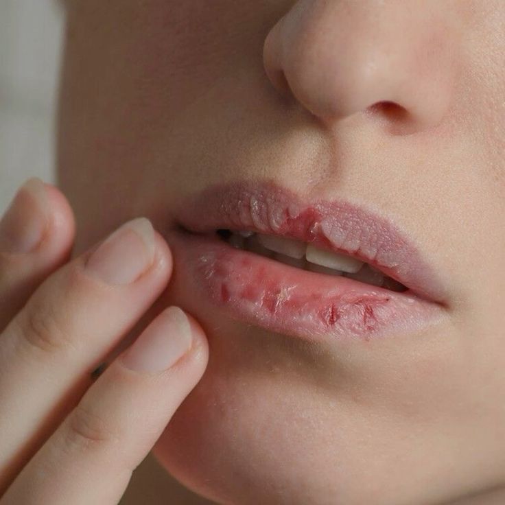 Dry & Cracked Lips