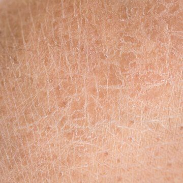 Dryness & Rough Texture