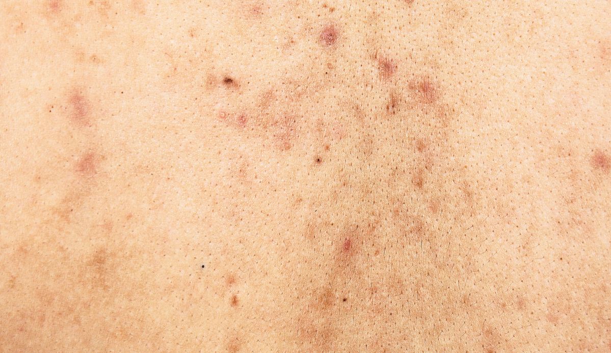 Dull Skin & Uneven Tone