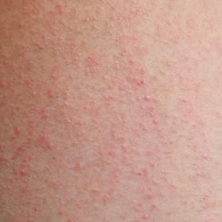 Skin Irritation & Sensitivity