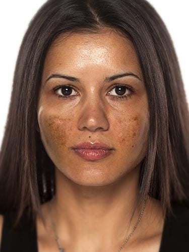 Hyperpigmentation & Uneven Tone